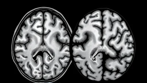 Brain imaging errors reveal hidden aging patterns in mental illness (Bild 1)